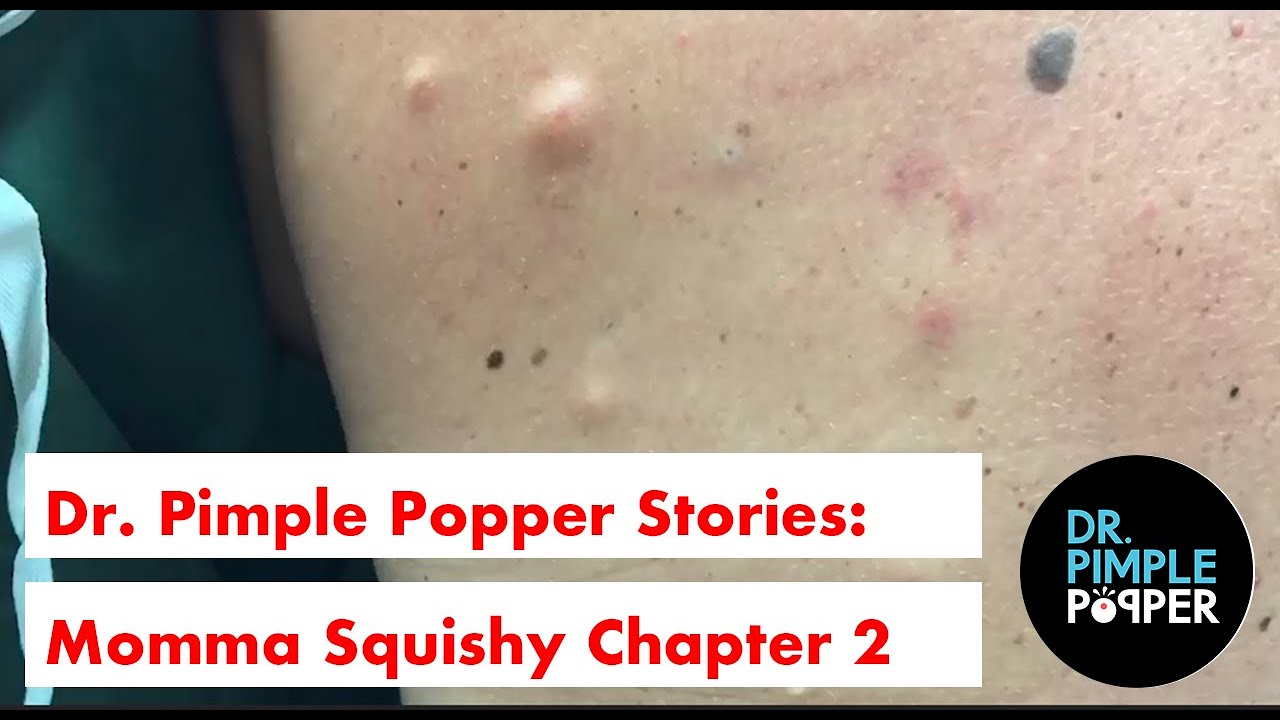 Dr. Pimple Popper’s Weekly Story Time: Momma Squishy, Chapter 2
