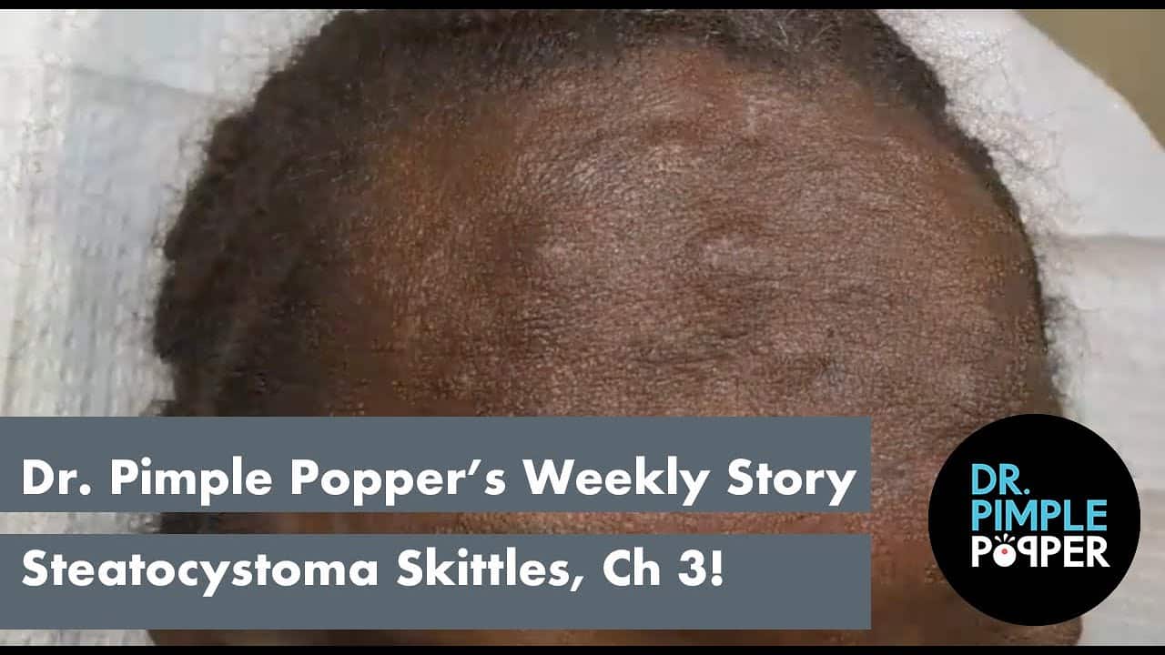Dr. Pimple Popper’s Weekly Story Time: Steatocystoma Skittles, Chapter 3!