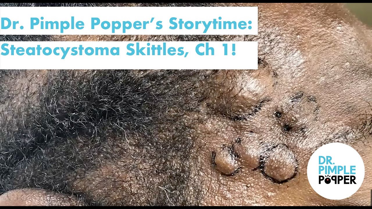 Dr. Pimple Popper's Weekly Story Time: Steatocystoma Skittles Chapter 1