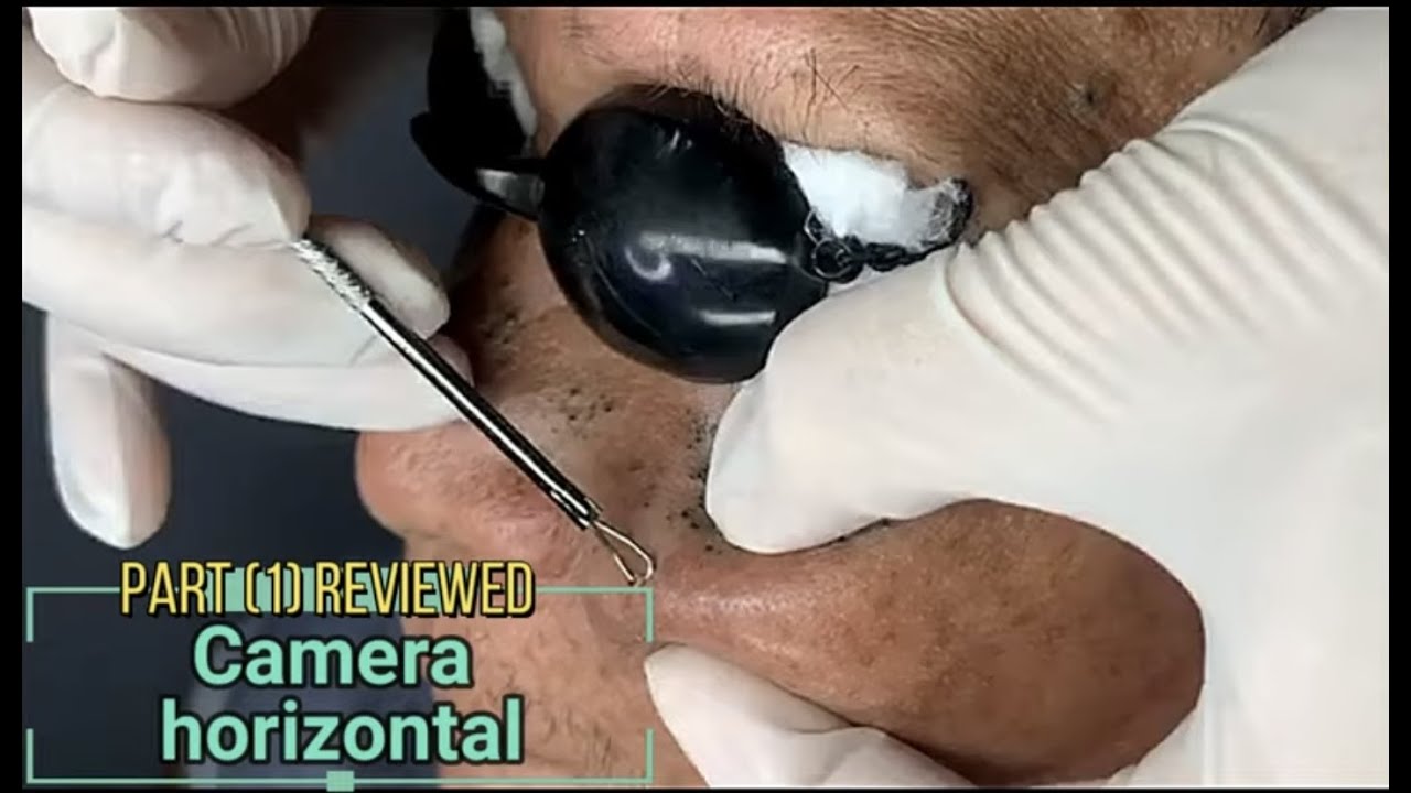 Dr Pop – Old deep blackheads removal & treatment 2020 (Part. 1) (Camera Reviewed)