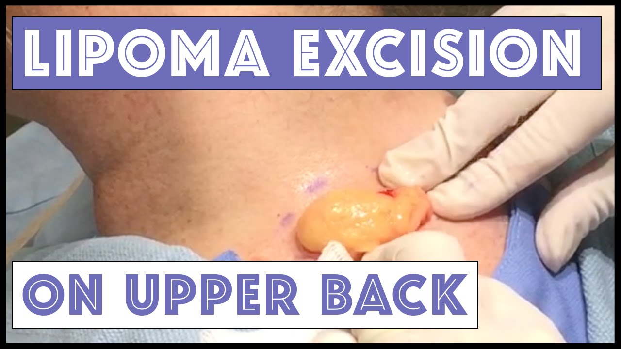 Dr Rebish Excises a Lipoma on the upper back
