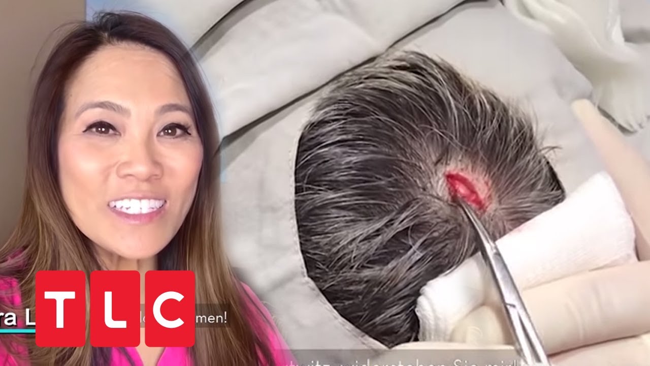 Dr. Sandra Lee entfernt Atherom vom Kopf eines Patienten | Dr. Pimple Popper | TLC Deutschland