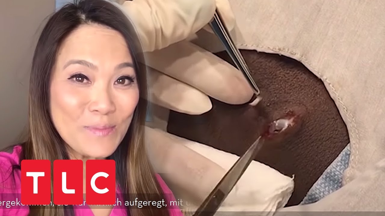 Dr. Sandra Lee entfernt Zyste mit Skalpell | Dr. Pimple Popper