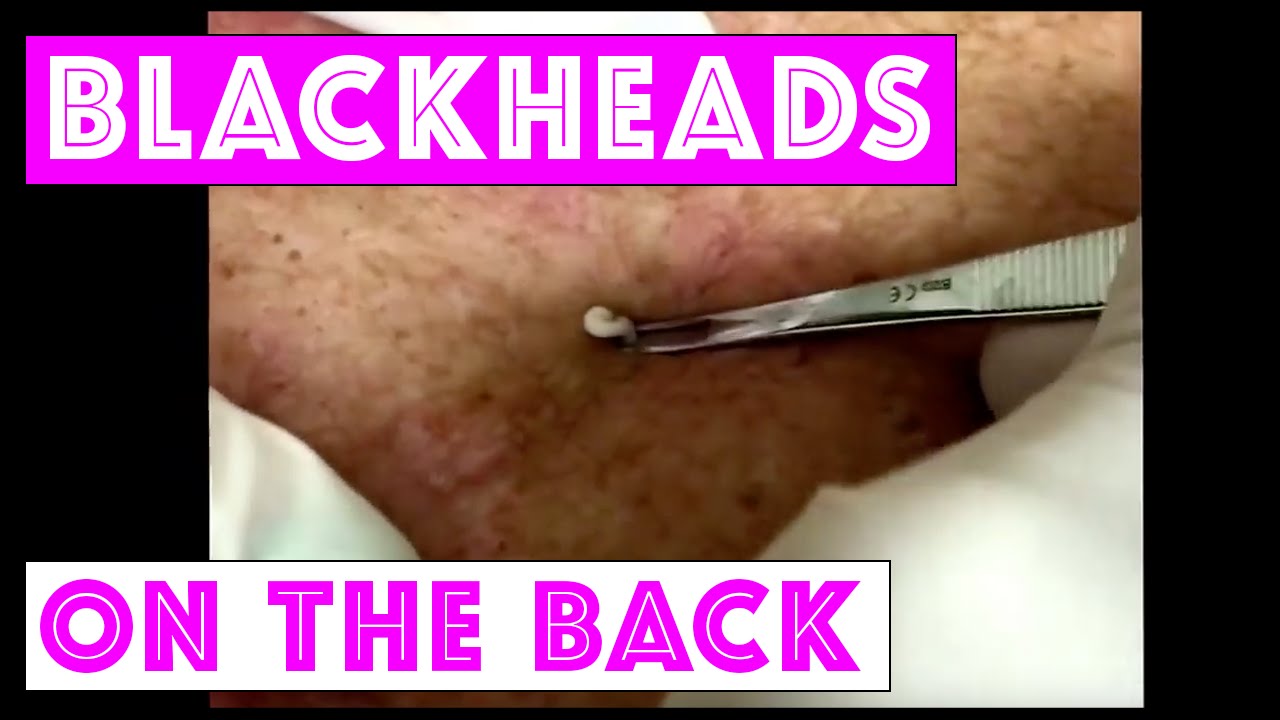 Dr Sandra Lee Extracting blackheads on the back. For medical education- NSFE.