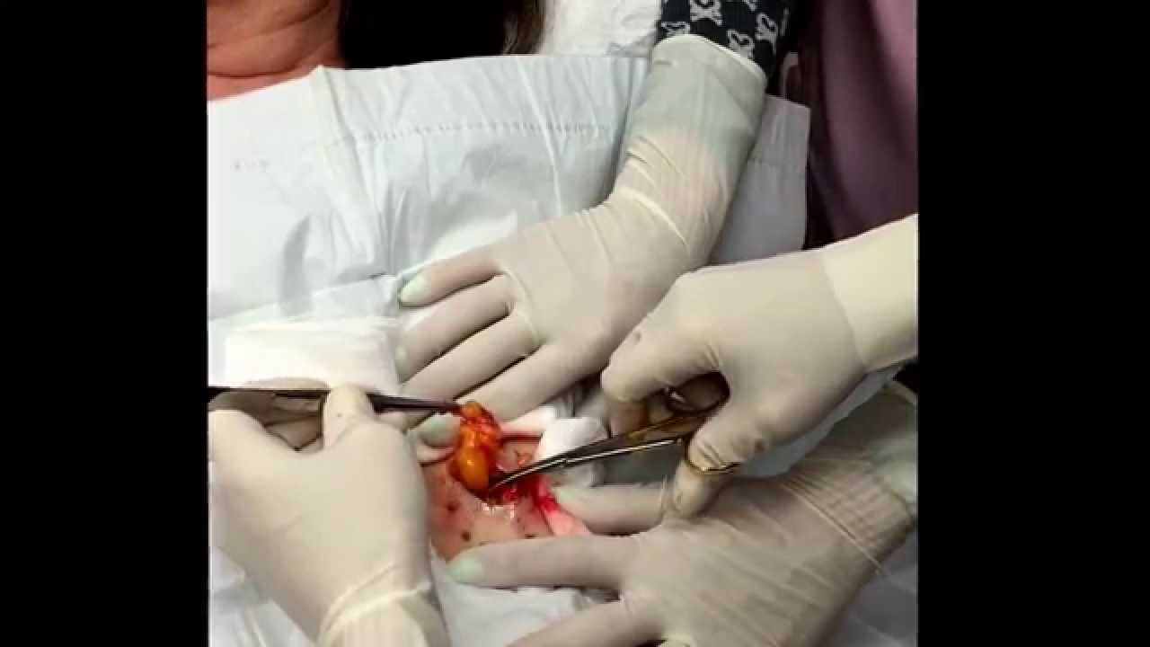 Dr Sandra Lee removes a lipoma from the forearm. For medical education- NSFE.