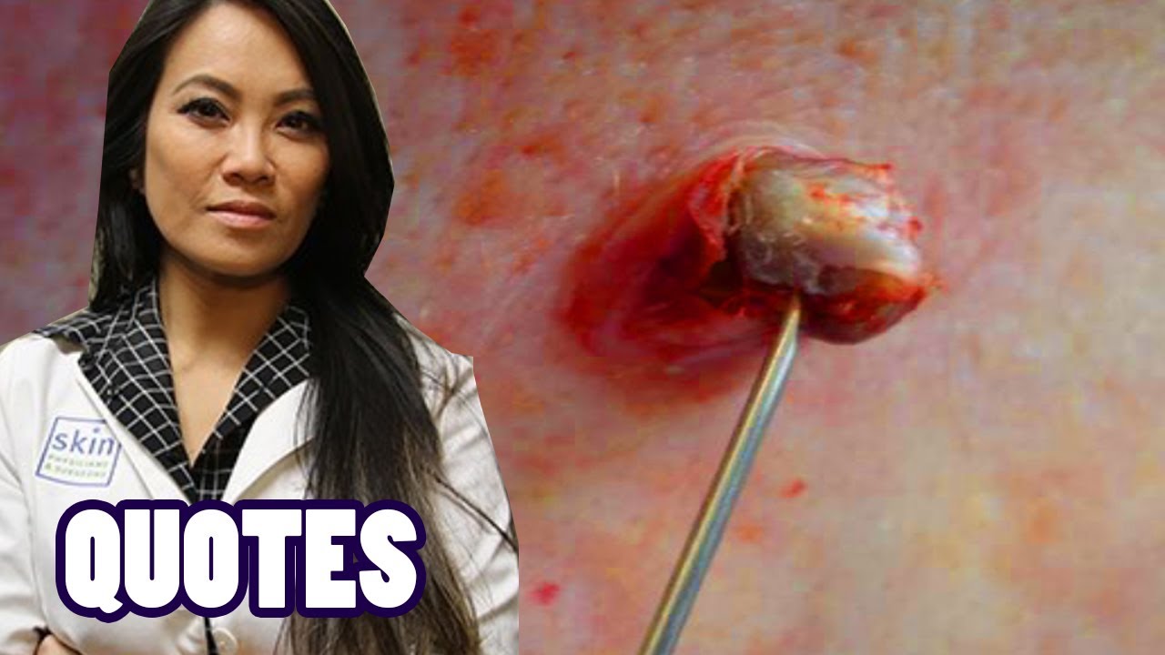 Dr. Sandra Lee’s Best Pimple Popping Quotes! (Popping Clips Not by Dr. Lee)
