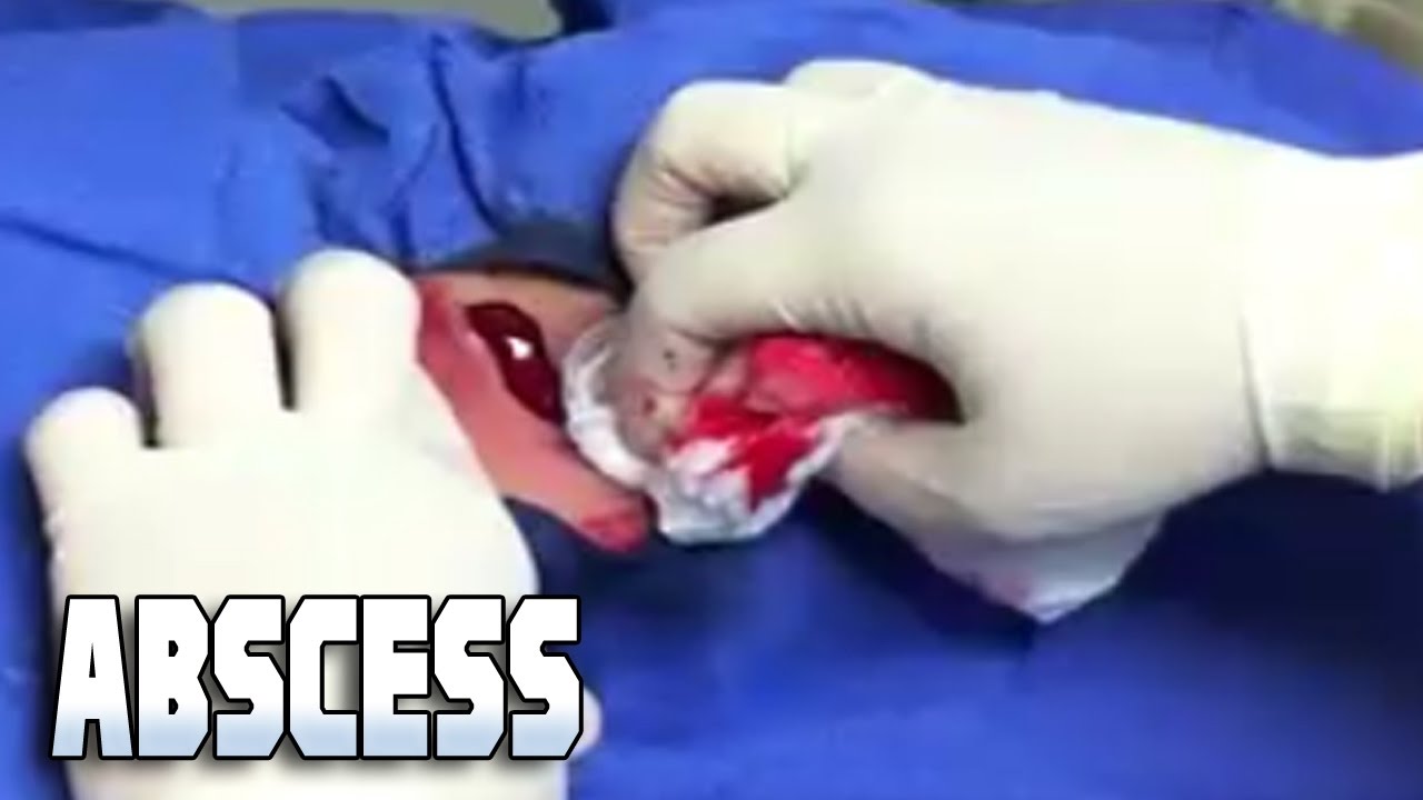 Drain That Abscess!  Popping, Pimples, Zits, Infections & Medical Footage