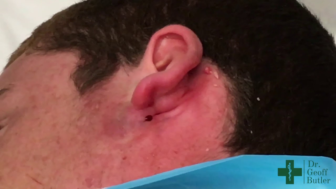 Drainage of an infected cyst behind the ear