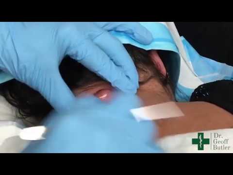 Drainage of an infected epidermal cyst at the base of the neck