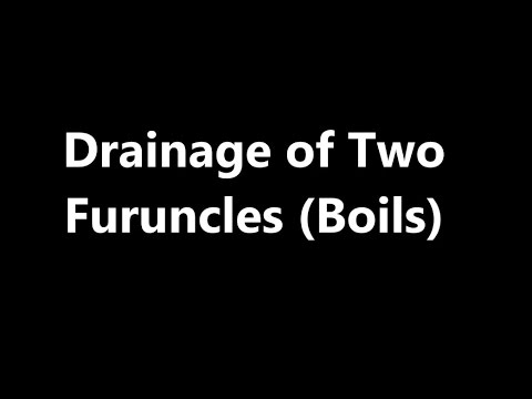 Drainage of Two Furuncles (Boils)