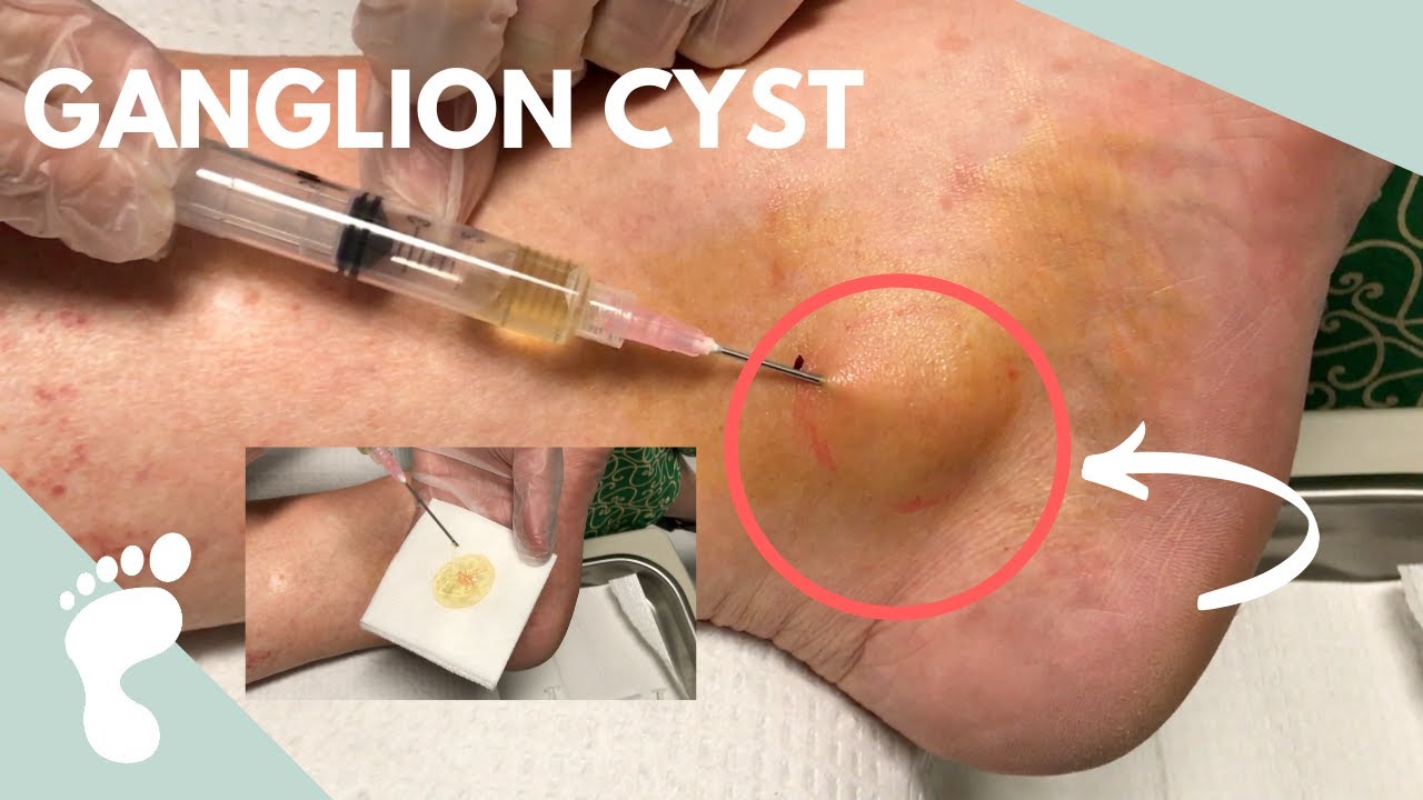 Draining a Ganglion Cyst Using a Syringe!