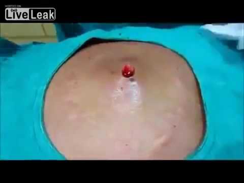 Draining A Large Infected Cyst