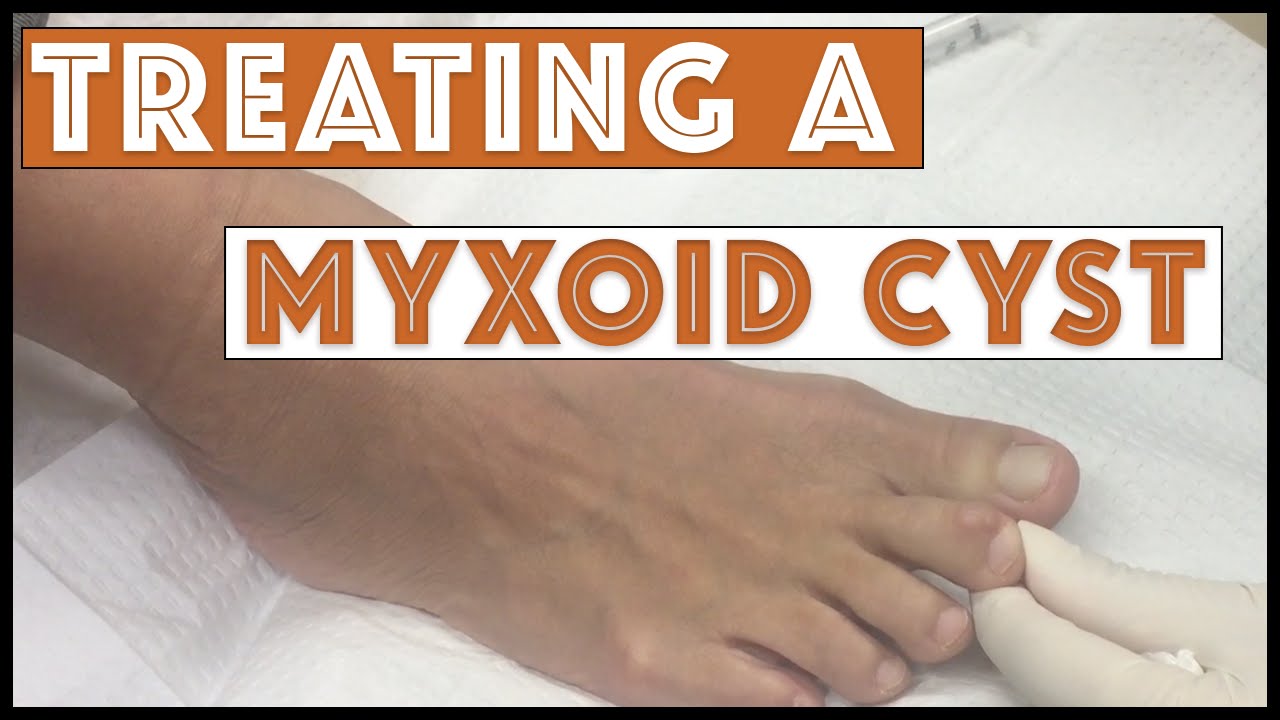 Draining & treating a Myxoid Cyst