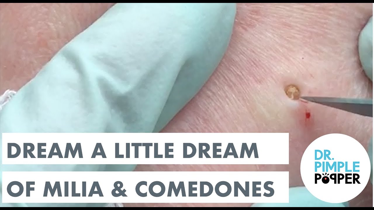 Dream A Little Dream of Milia & Comedones: MEDLEY