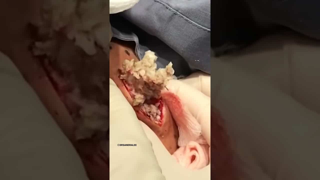 #drpimplepopper squeezes a BLOOMIN' Cyst | #shorts #youtubeshorts #pimple #oddlysatisfying