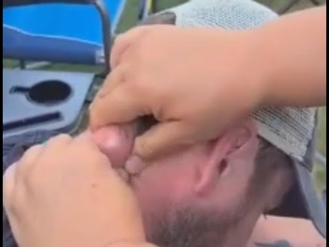 Dude Has His Giant Cyst Popped!