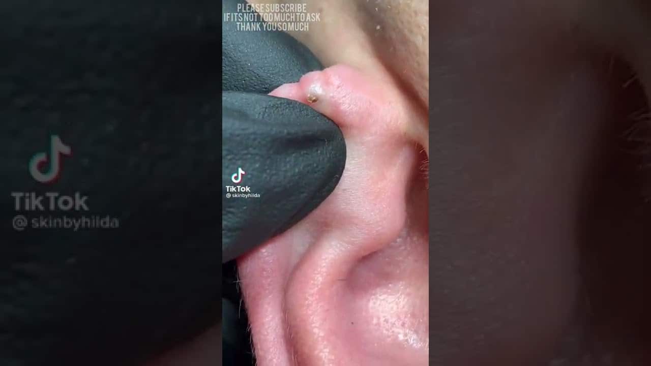 EAR BLACKHEAD EXTRACTION COMPILATION 7 | BLACKHEAD IN EAR | EAR BLACKHEADA THIS WEEK
