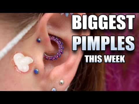Ear Blackheads, Pimple Popping, Dilated Pores of Winer (DPoW) and Senile Comedones