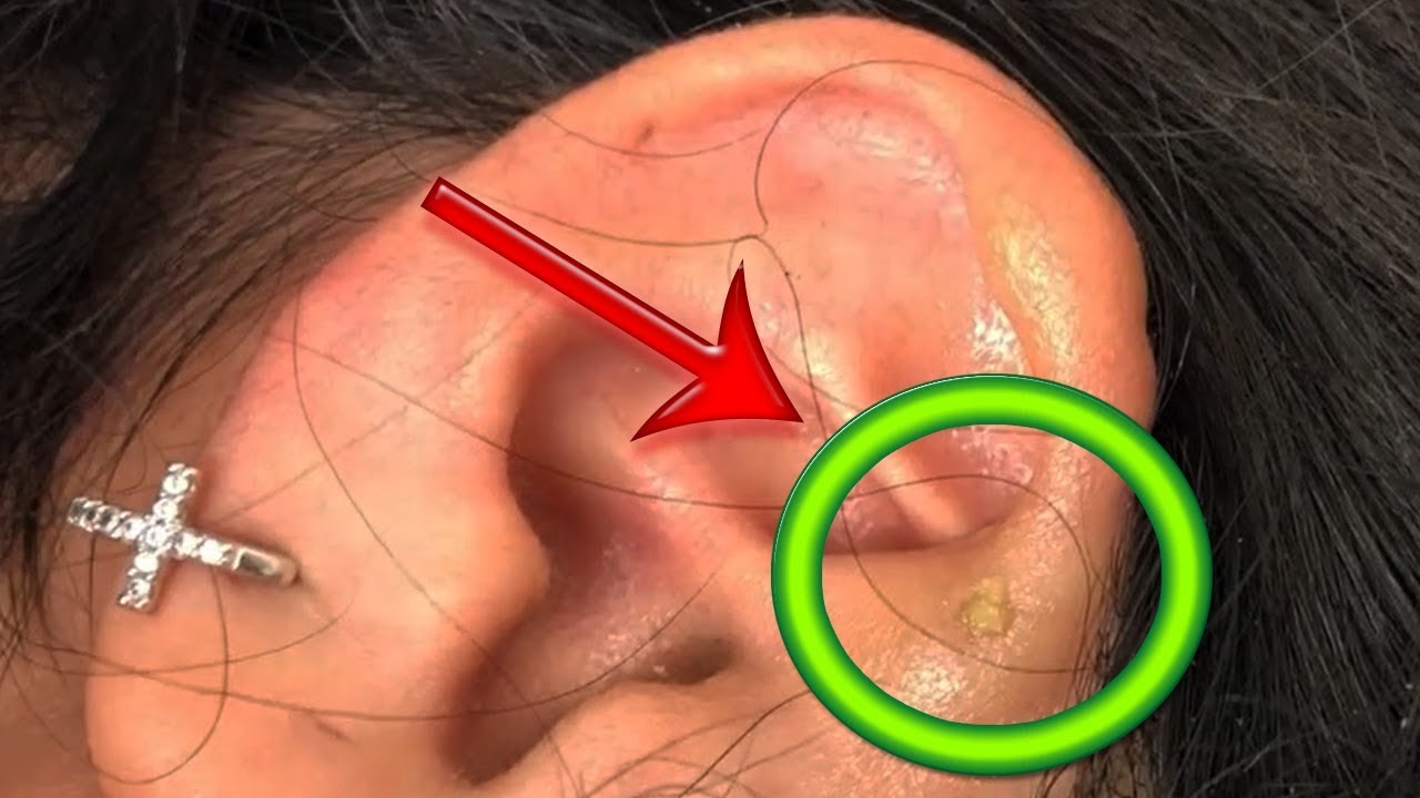 Ear Blackheads & Pimples?   One Little Pop