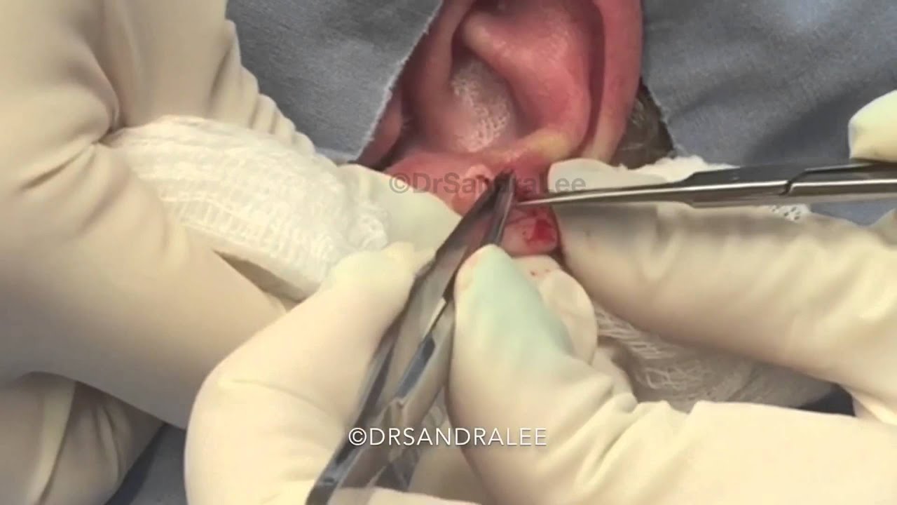 Ear cyst POPPED. For medical education- NSFE.