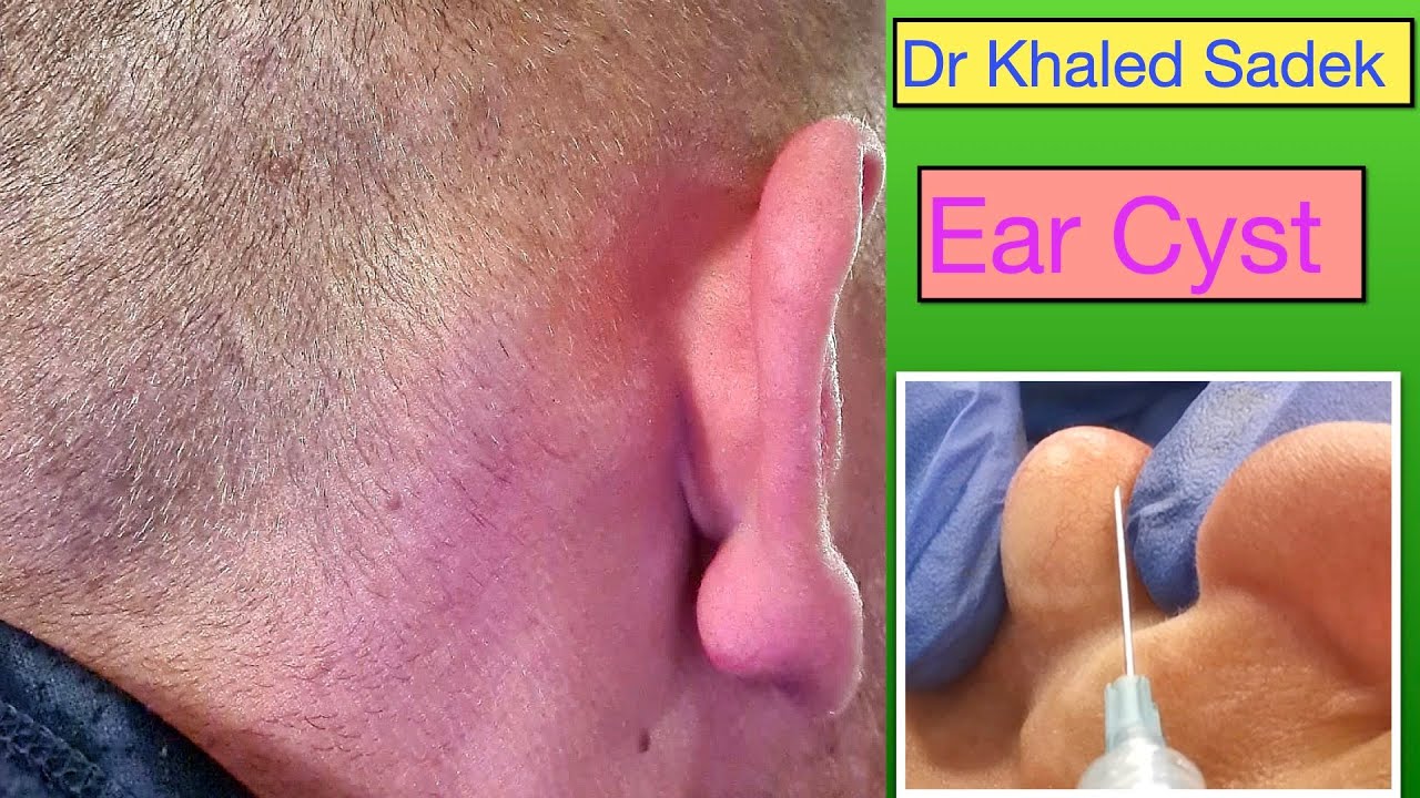 Ear-Cystable! Great big ear cyst. Dr Khaled Sadek. LipomaCyst.com