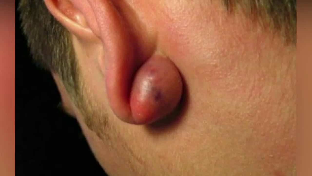 Ear Cysts And Ear Abscesses