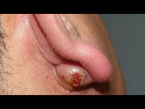 Ear Cysts!  Whiteheads, Pimples, Acne and Relaxing Comedones