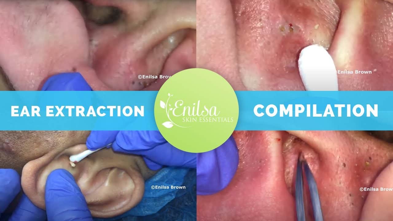 Ear Extraction Compilation
