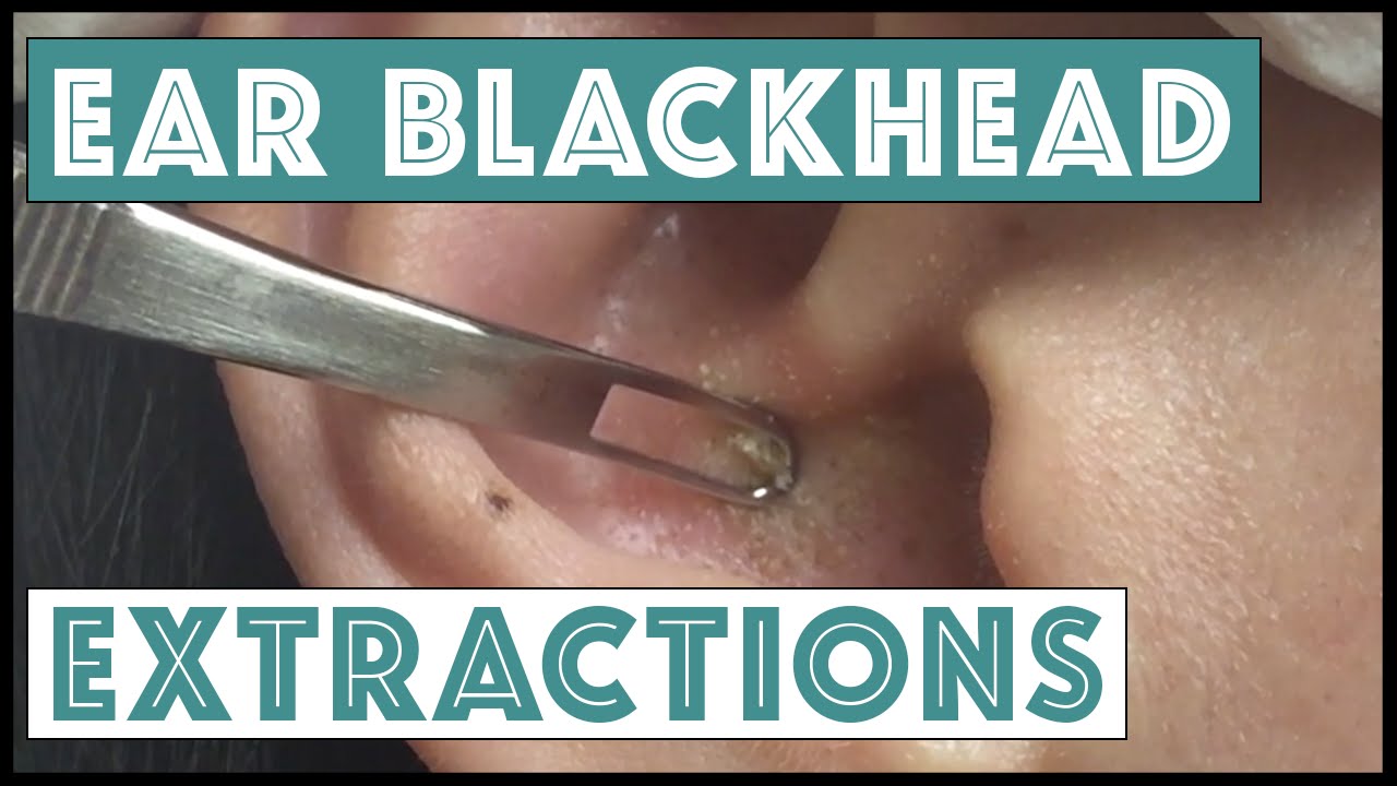 Ear Extractions