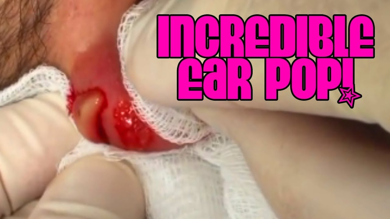 Ear Filled with THICK Pus! – Dr. Gilmore Removal Video!