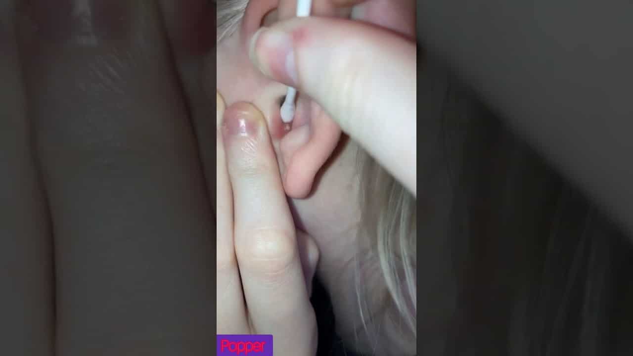 Ear Pimple Pop