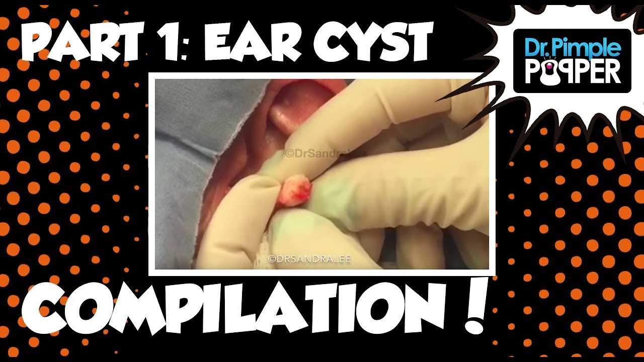 Ear Ya GO! ??Ear Cyst Compilation Part I