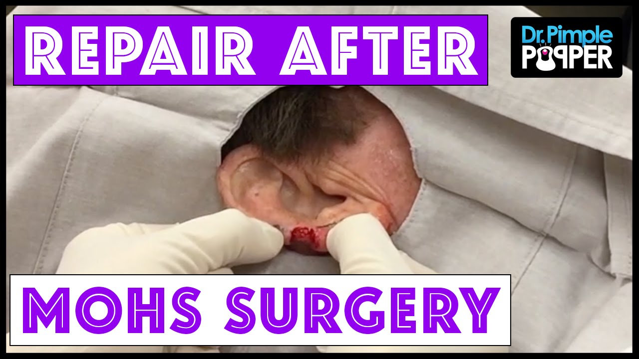 Earlobe Repair after Skin Cancer Removal (Mohs Surgery)