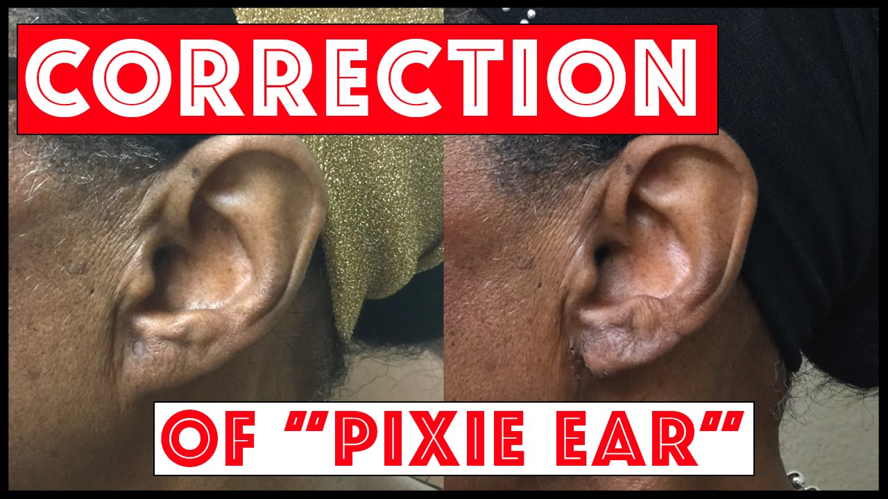 Earlobe repair: Fixing “pixie ear” created after a face lift procedure