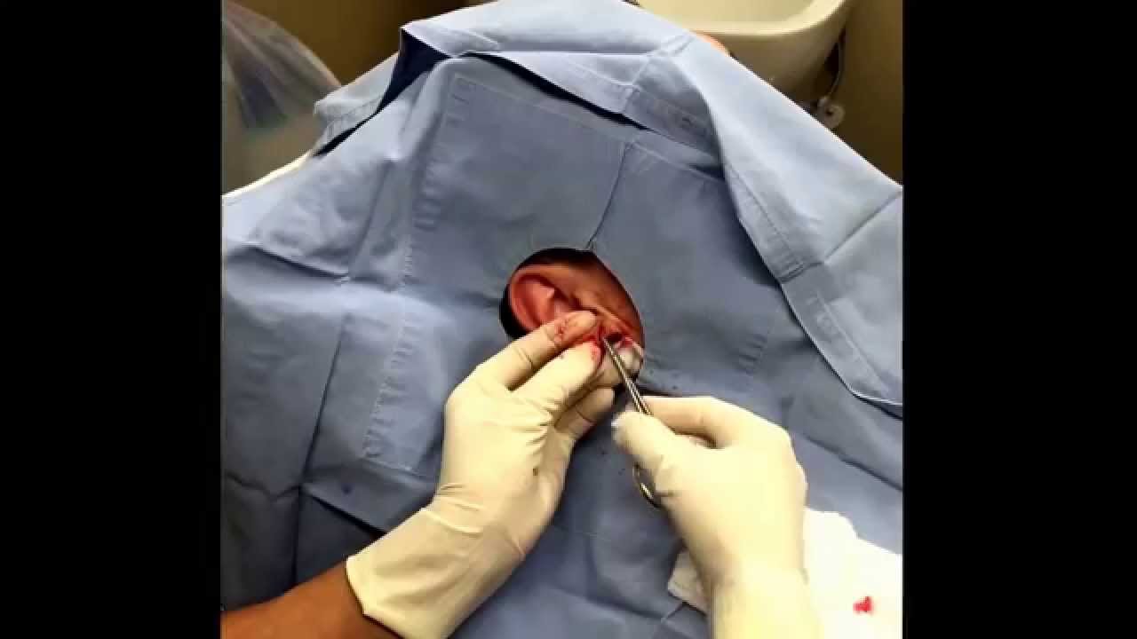 Earlobe repair: full excision and repair to right side. For medical education- NSFE.