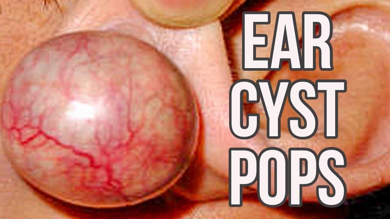 Earlobe Sac Cyst Busting | Educational Ear Bumps Popped