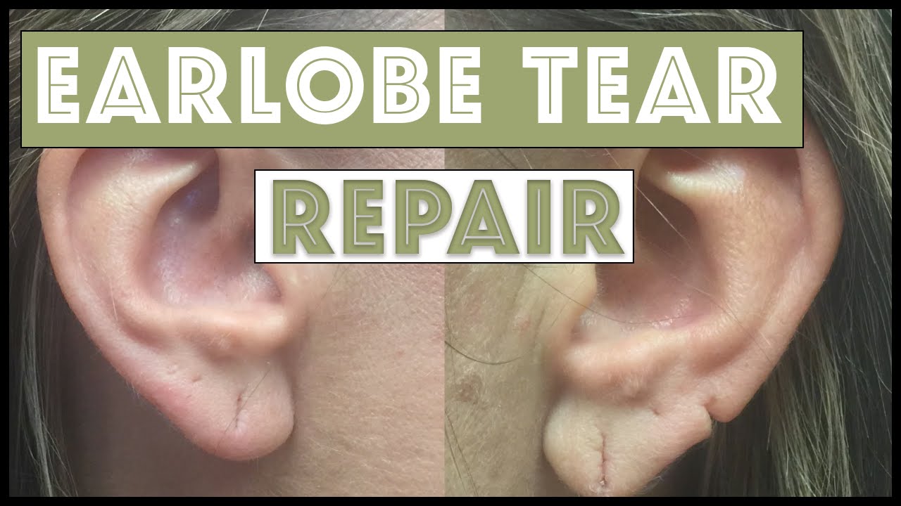 Earlobe Tear Repair