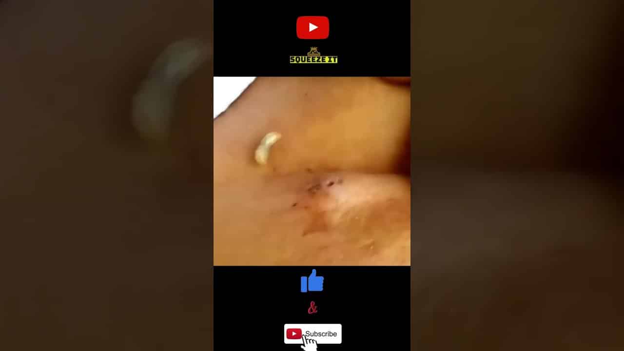 Easy Bot Fly Removal (Pimple Popper) Squeeze It #Shorts