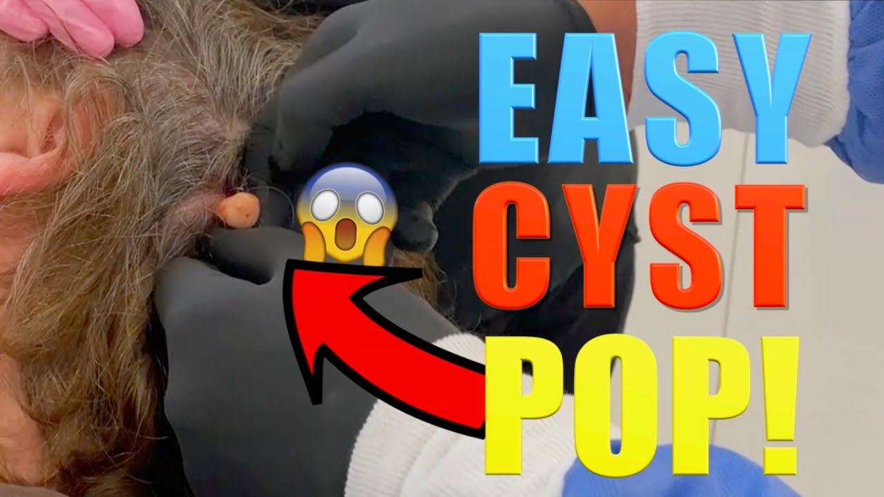 EASY CYST POP!