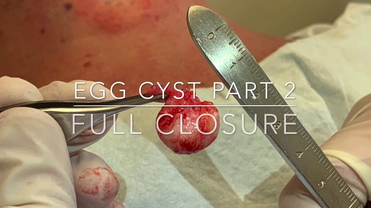 Egg cyst Part 2- full length closure. Mr PopZit