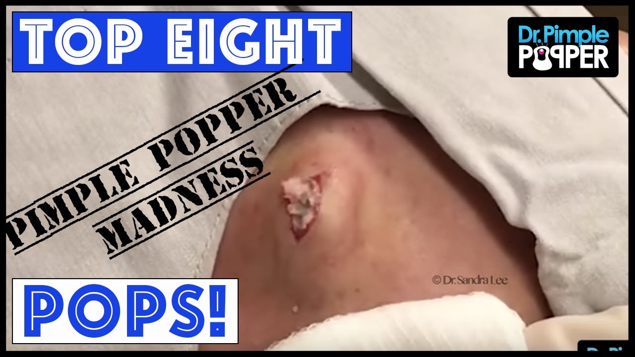 EIGHT POPS for you – PIMPLE POPPER MADNESS!!