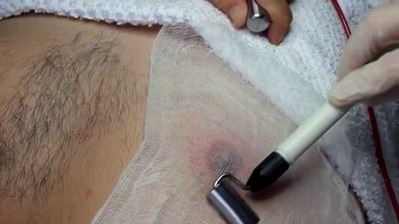 Electrolysis Around the Male Nipple.