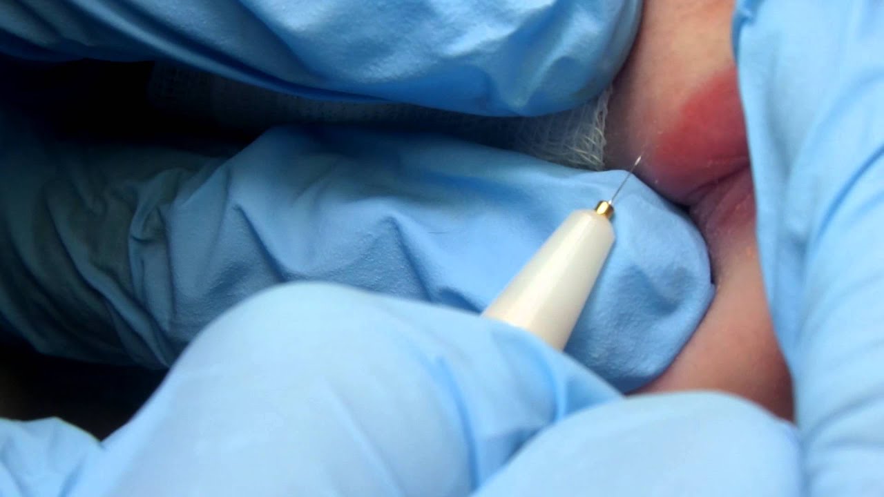 Electrolysis hair removal on the female upper lip (peach fuzz)
