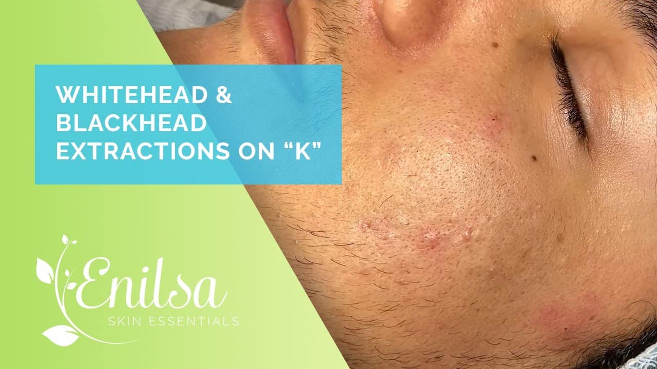 Enilsa is back! Whitehead & Blackhead Extractions on “K” – Part 1