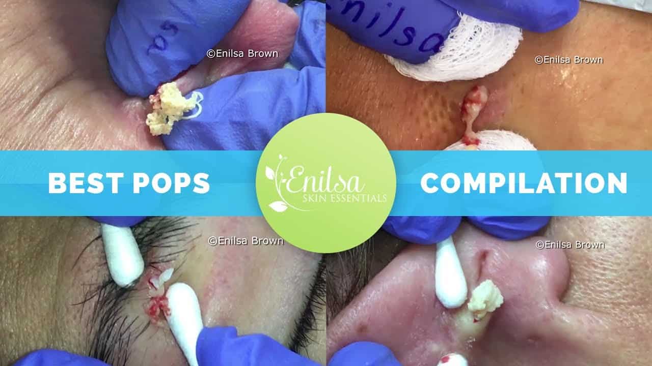 Enilsa's Top 5 Best Cyst Popping Compilation