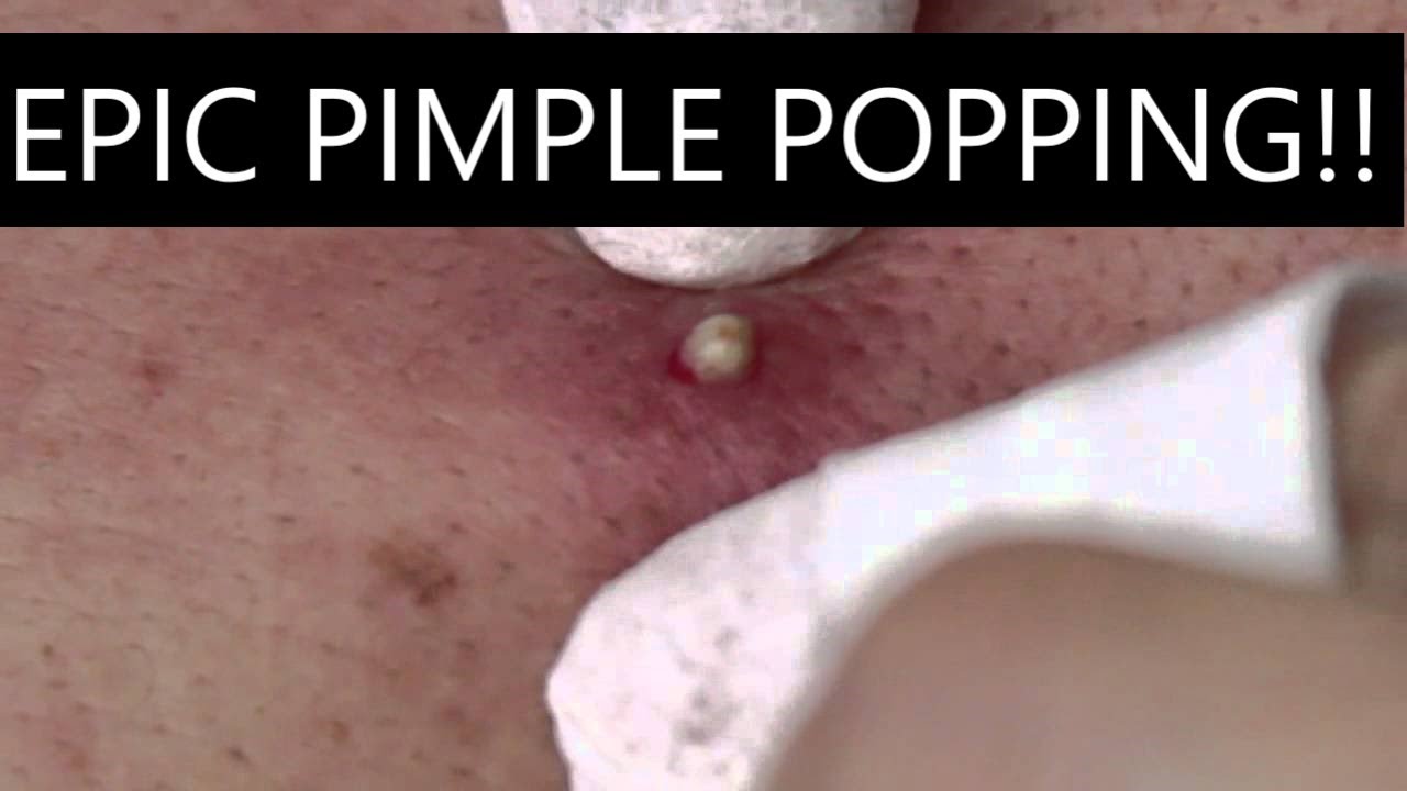 EPIC Pimple Popping COMPILATION!!!