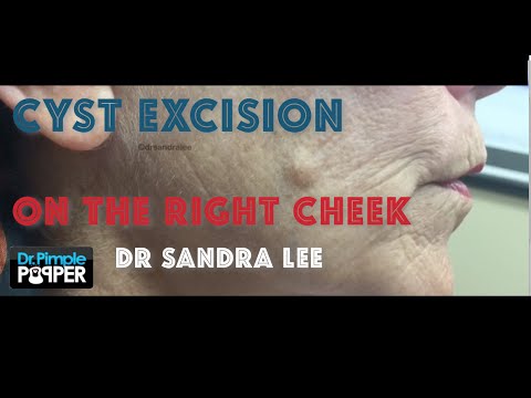 Epidermoid cyst excision on the cheek