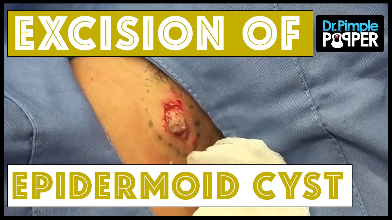 Epidermoid Cyst Excision, Posterior Neck, and Skin Biopsy