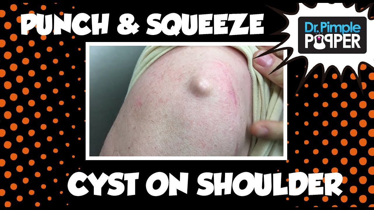 Epidermoid Cyst on the Shoulder Excised – The Size of a Marble