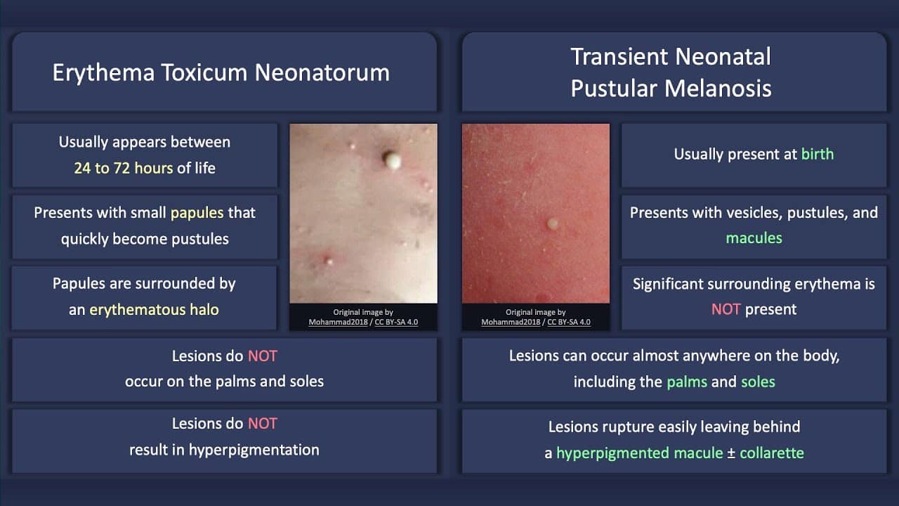 Erythema Toxicum Neonatorum vs. Transient Neonatal Pustular Melanosis